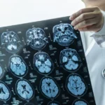 Depression after a brain injury is a distinct condition, study finds. That could change how it’s treated.